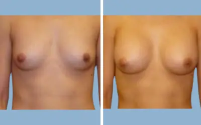 Before and After
